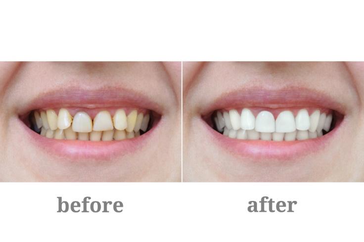 What Happens If You Don't Fix a Cavity? - Smile Designers San Diego